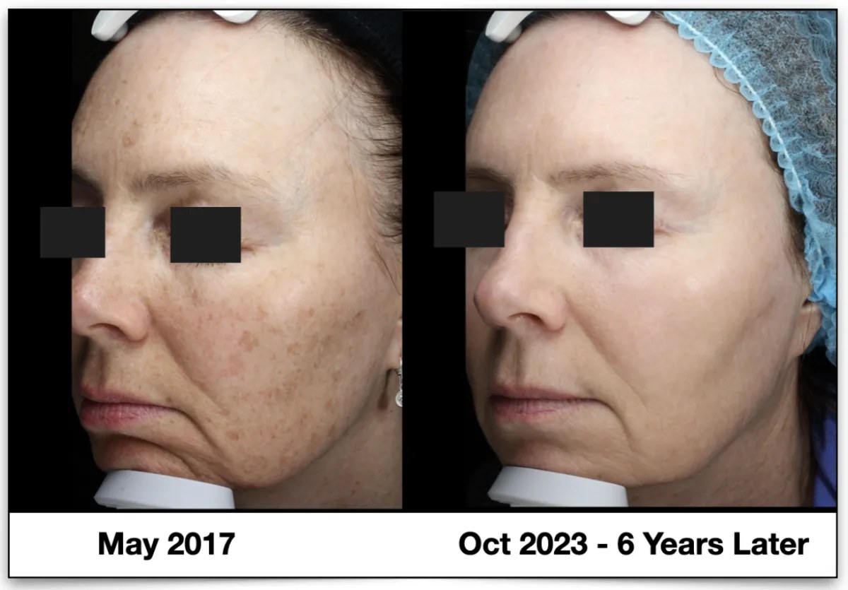 Real patient before and after BBL: brown pigmentation in May 2017, clearer skin in October 2023