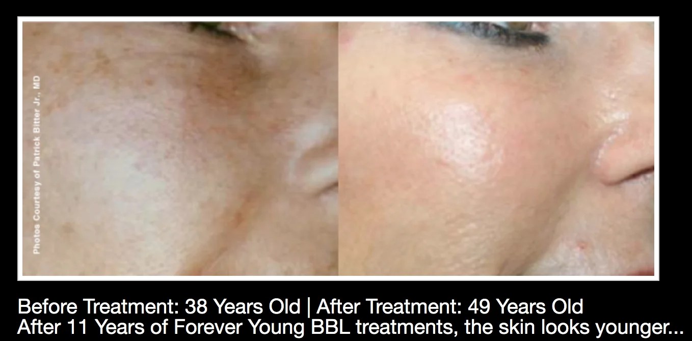 Before and after regular BBL treatment: Patient — age 38 to 49